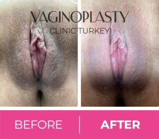 Labial Puff Before / After