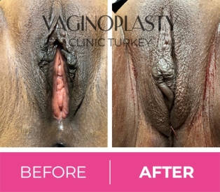 Vaginoplasty (cystorectocele correction) and perineoplasty before
