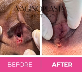 Hymenoplasty Before and After