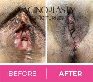 Vaginoplasty Before / After
